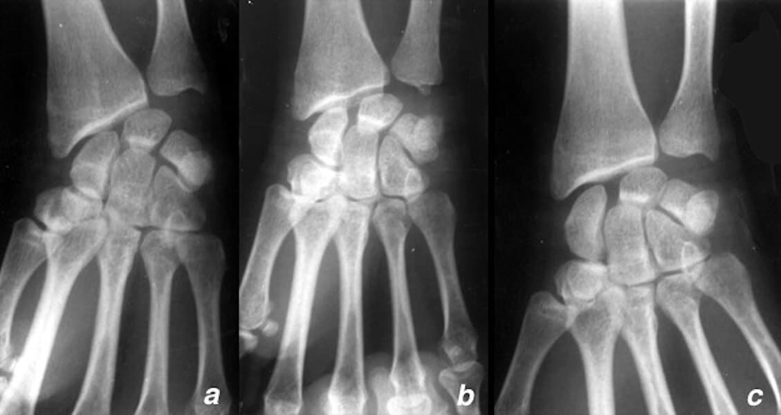 radiographie poignet entorse